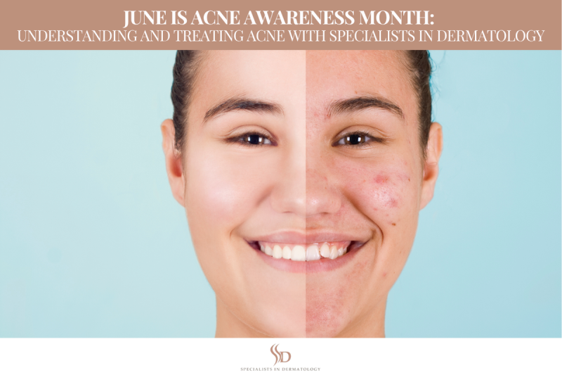 June is Acne Awareness Month Understanding and Treating Acne with Specialists in Dermatology