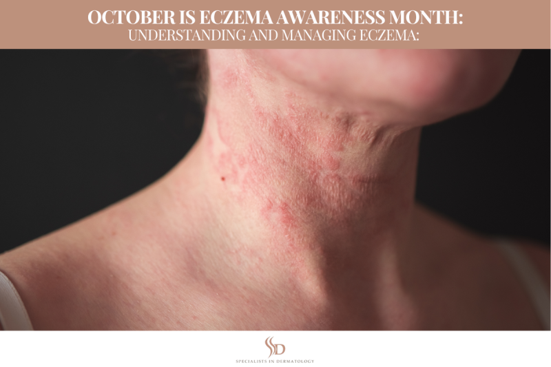October is Eczema Awareness Month: Understanding and Managing Eczema