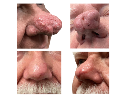 Rhinophyma